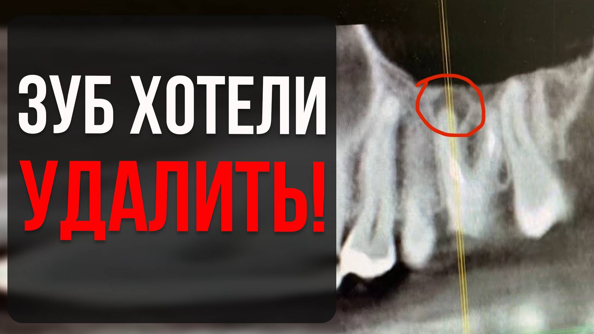 Пациентку готовили к удалению… Но мы спасли зуб!