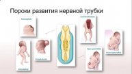 Нарушение эмбрионального развития при spina bifida