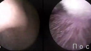 Турбинопластика ДО и ПОСЛЕ