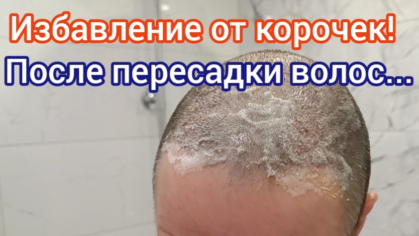 Как избавиться от корочек после пересадки волос. Чем мыть голову?