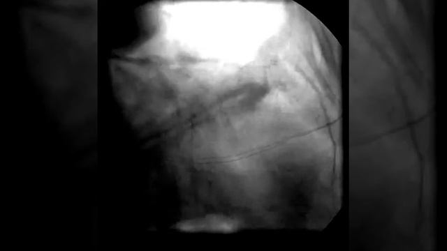 Heart стент хирургия смотреть онлайн