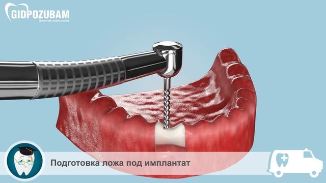 Съемные протезы на имплантах. Методика установки съемного протеза на импланты смотреть онлайн