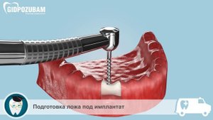 Съемные протезы на имплантах. Методика установки съемного протеза на импланты