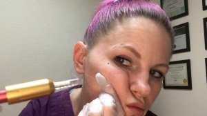 HYALURON PEN: JAWLINE + CHIN FILLER