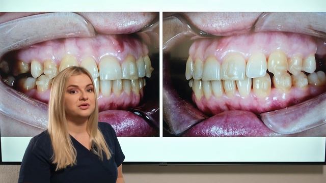 На что способны элайнеры. Подготовка к имплантации