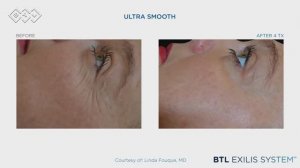 BTL exilis ultra 360