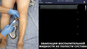 Пункция коленного сустава с УЗИ