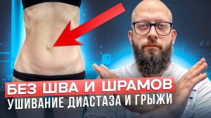 Авторская методика ушивания диастаза через пупок