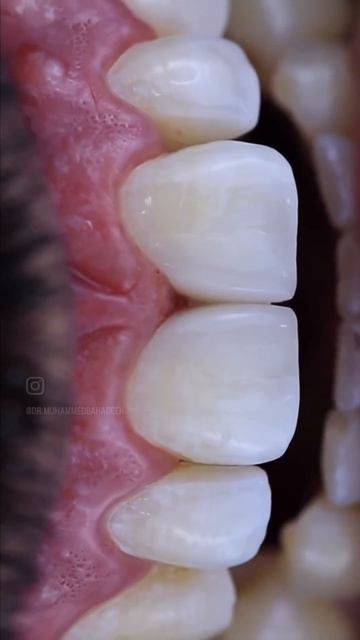 غلق الفراغات.diastema closure. смотреть онлайн