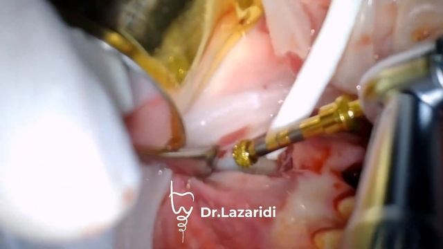 УДАЛЕНИЕ КИСТЫ ГАЙМОРОВОЙ ПАЗУХИ VISTA ДОСТУПОМ \ MAXILLARY SINUS CYST ENUCLEATED BY VISTA APPROACH