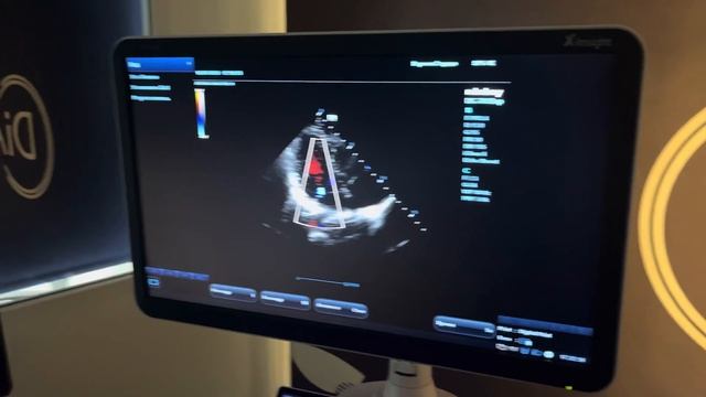 Обзор УЗИ аппаратов: Mindray DC 70 pro, Alpinion Ecube8, SIUI 5800 и SIUI 5300. Сердце. смотреть онлайн