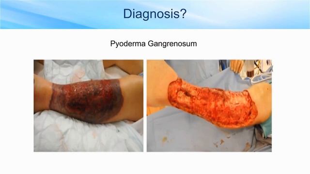 Translating Consensus Guidelines Updates to Clinical Practice: Best Practice Use for NPWTi смотреть онлайн