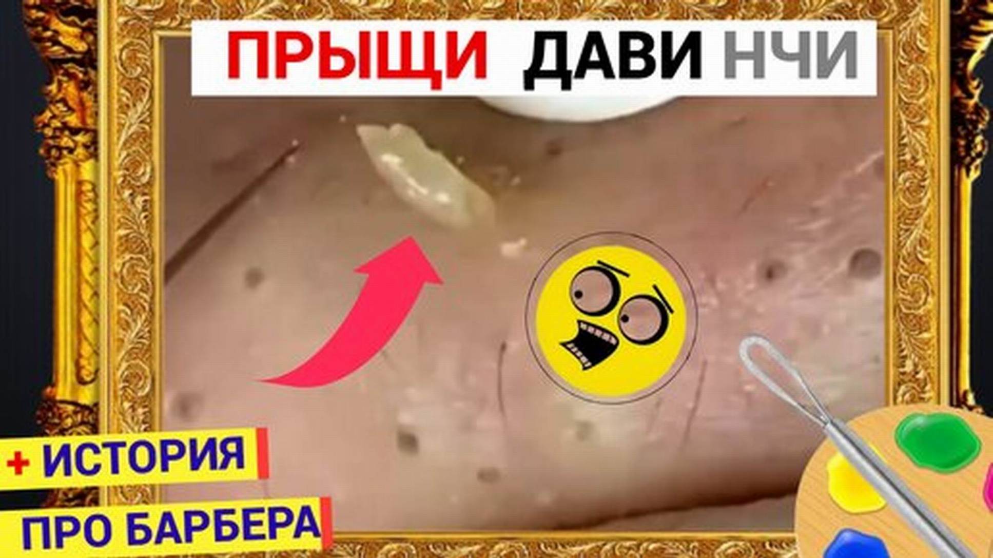 Прыщи 046 Комедон КОЛБАСКОЙ Выдавили. Такие Черные Точки не Нужны Ведь Правда. История про барбера