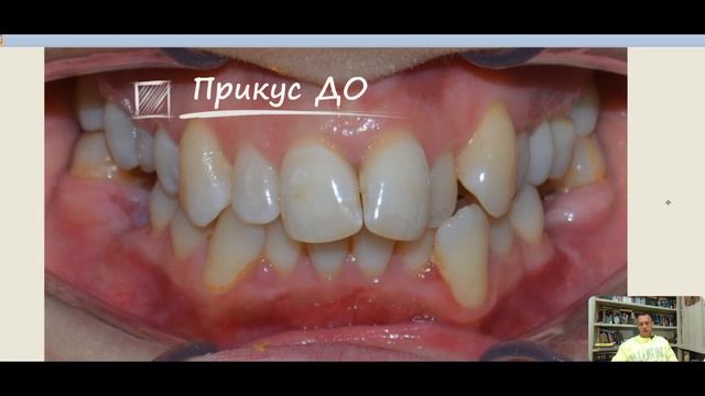 Скученность зубов, узкий верх, до/после! смотреть онлайн