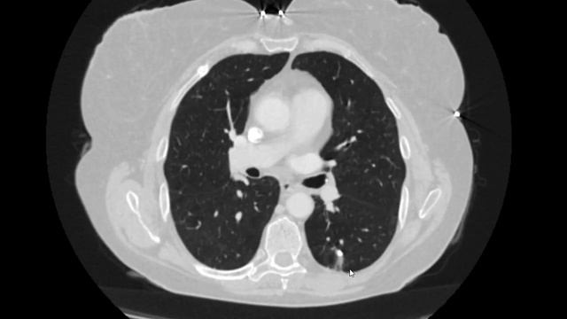 Пневмонія або перелом. смотреть онлайн