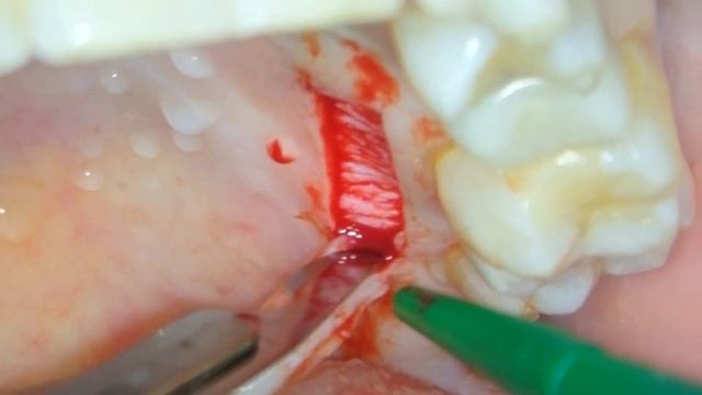 Keratinized tissue improvement around dental implant.