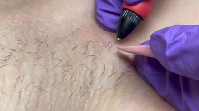 электроэпиляция