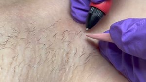 электроэпиляция