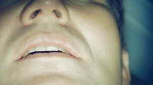 Инфильтрационная анестезия.Для Лечения 16. Кейс #90.