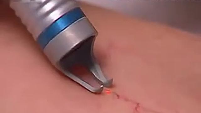 Zamykanie naczynek laserem CAPILASE 980nm смотреть онлайн