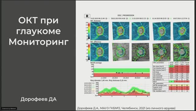 Мониторинг глаукомы, прогрессирование глаукомы по данным ОКТ