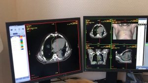 Учебный фильм "Разметка пациента перед лучевой терапией"