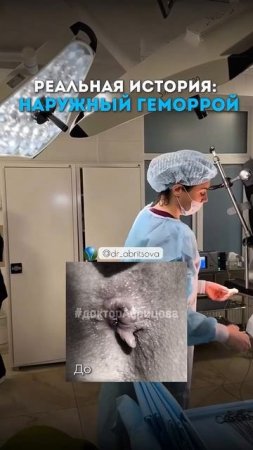 Наружный геморрой до операции и после 🍑 #проктолог