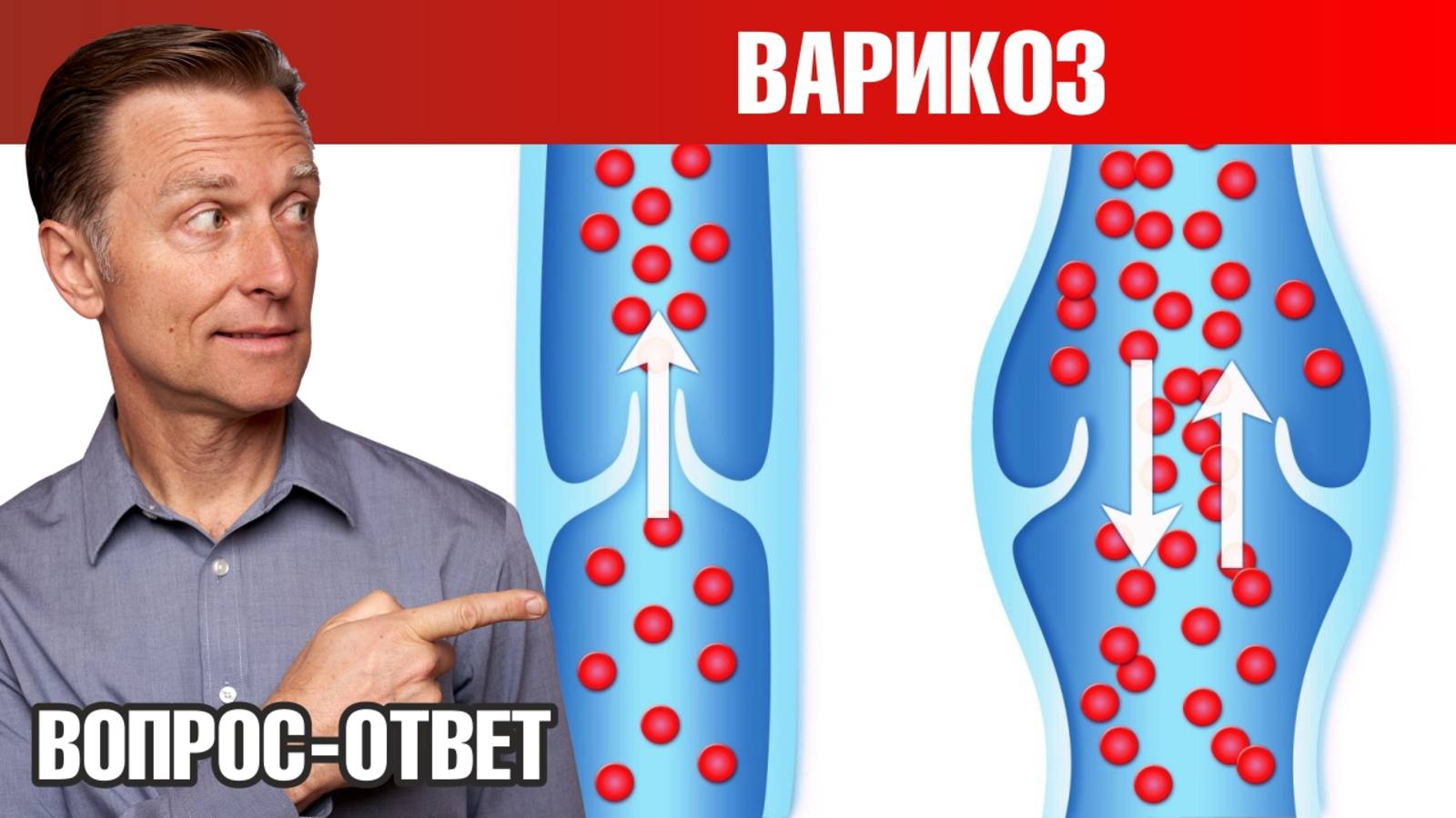 Как избавиться от варикоза 👉 лучший способ и профилактика
