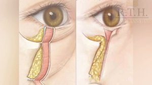 Блефаропластика с перераспределением собственного жира