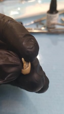 Стекловолоконный штифт в действии. Спустя 2 года) ставил не я)