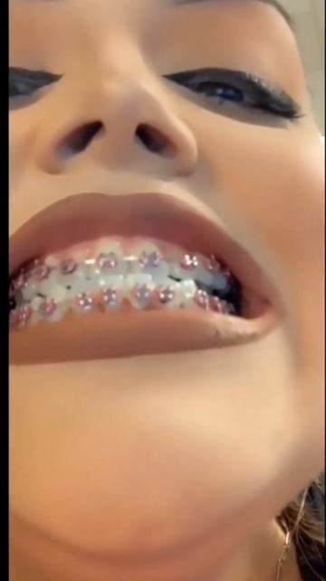 Брекеты для взрослых игор смотреть онлайн