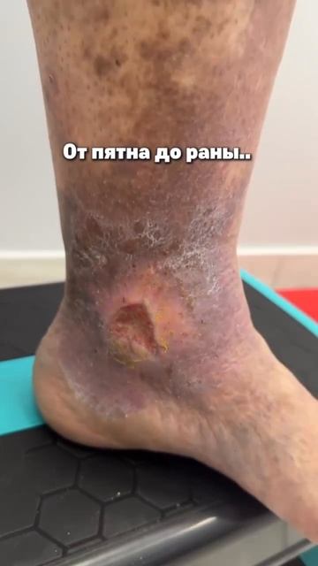 Венозные язвы