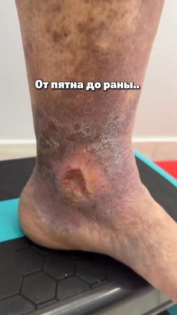 Венозные язвы