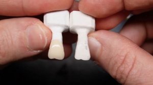 Виниры на Рефракторе