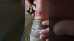 Как избежать гангрены при сахарном диабете второго типа?