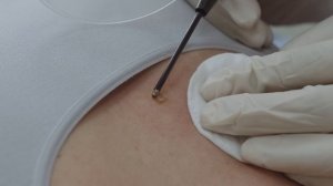 Радиоволновая хирургия.