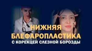Нижняя блефаропластика с перемещением жировых грыж: результат через год