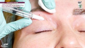 Мезотерапія періорбітальної зони Dermaheal SR💚.  Папульна техніка