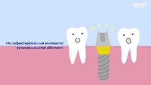 Имплантация: процедура лечения