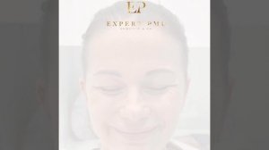 Миотокс до после