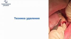 Удаление зубов