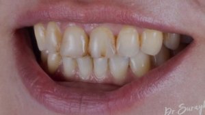 Новая улыбка .Закончил клинический случай с керамическими винирами и керамическими коронками