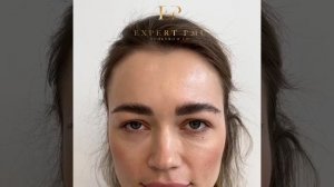 Диспорт до после