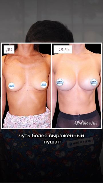 Что такое проекция грудных имплантов?