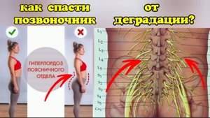 Лордоз поясницы душит нервы и сосуды ног, половых органов. Методы оздоровления позвоночника
