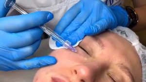 Мезотерапия под глаза Meso Eye