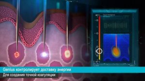 Lutronic Genius