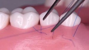 Обвивной шов