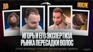 Игорь и его экспертиза рынка пересадки волос. Выбор Игоря - ГеоГрафт