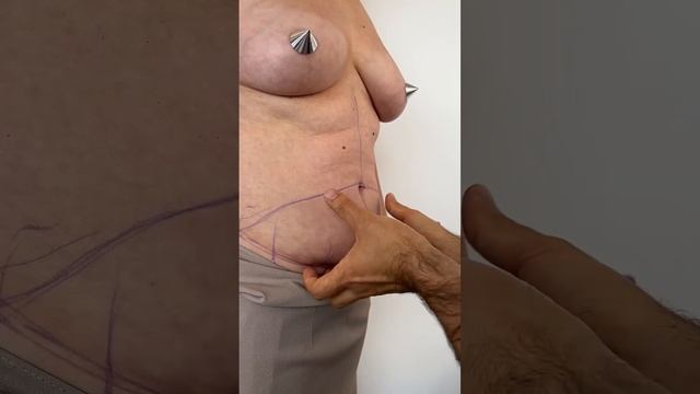 КОМПЛЕКСНАЯ ОПЕРАЦИЯ НА ВЕКАХ, ЛИЦЕ И ЖИВОТЕ. Доктор Карапетян